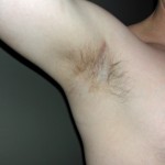 pectoral-implant-scars-dr-barry-eppley-indianapolis
