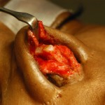 rhinoplasty-rib-cartilage-grafts-dr-barry-eppley-indianapolis1