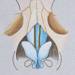 spreader-grafts-in-rhinoplasty-dr-barry-eppley-indianapolis
