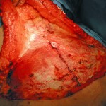 tummy-tuck-rectus-muscle-plication-dr-barry-eppley-indianapolis