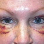 blepharoplasty-the-first-week-after-surgery-dr-barry-eppley-indianapolis