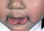 frenuloplasty-tongue-tie-repair-dr-barry-eppley-indianapolis