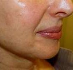 nasolabial-fold-treatment-strip-fat-graft-dr-barry-eppley-indianapolis