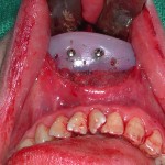 chin-implant-on-top-of-osteotomy-dr-barry-eppley-indianapolis