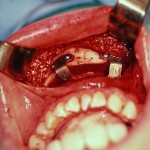 chin-osteotomy-dr-barry-eppley-indianapolis