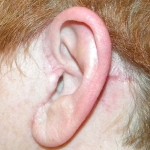 facelifting-scars-indianapolis-dr-barry-eppley