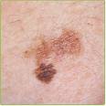 melanoma-dr-barry-eppley-indianapolis1