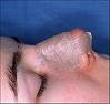 rhinoplasty-nosejob-dressing-splint-dr-barry-eppley-indianapolis