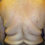smartlipo-back-rolls-dr-barry-eppley-indianapolis