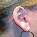 facelift-ear-scars-indianapolis-dr-barry-eppley