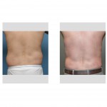 love-handle-liposuction-smartlipo-dr-barry-eppley-indianapolis