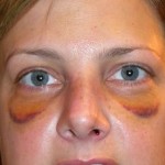 rhinoplasty-recovery-dr-barry-eppley-indianapolis1
