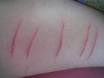 self-mutilation-scar-revision-dr-barry-eppley-indianapolis