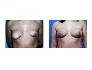 tuberous-breast-deformity-dr-barry-eppley-indianapolis