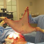 abdominoplasty-pannus-removal-dr-barry-eppley-indianapolis