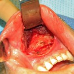chin-clefts-mentalis-muscle-separation-dr-barry-eppley-indianapolis1