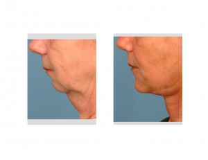 facelift-chin-implant-dr-barry-eppley-indianapolis