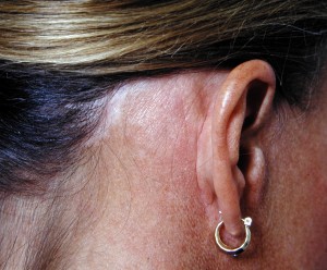 facelift-scalp-scars-dr-barry-eppley-indianapolis