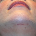 minimal-incision-chin-augmentation-dr-barry-eppley-indianapolis