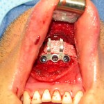 vertical-chin-lengthening-with-plates-and-grafts-dr-barry-eppley-indianapolis