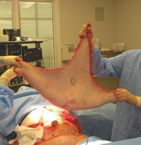 abdominal-pannus-removal-dr-barry-eppley-indianapolis