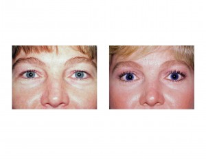 blepharoplasty-eyelid-tuck-dr-barry-eppley-indianapolis