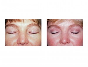 blepharoplasty-scars-eyelid-tucks-dr-barry-eppley-indianapolis