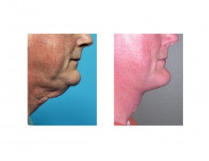direct-neck-lift-for-men-dr-barry-eppley-indianapolis