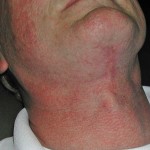 direct-neck-lift-scar-three-months-later-dr-barry-eppley-indianapolis