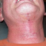 direct-neck-lift-scar-two-weeks-after-dr-barry-eppley-indianapolis