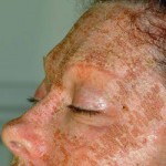 laser-resurfacing-dr-barry-eppley-indianapolis2
