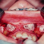 malar-and-paranasal-implants-dr-barry-eppley-indianapolis1