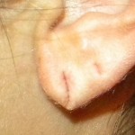 split-earlobe-dr-barry-eppley-indianapolis