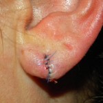 split-earlobe-repair-dr-barry-eppley-indianapolis