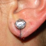 split-earlobe-repair-with-immediate-ear-ring-insertion-dr-barry-eppley-indianapolis