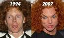 awful-plastic-surgery-in-men-dr-barry-eppley-indianapolis