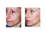 cheek-lift-surgery-dr-barry-eplpey-indianapolis