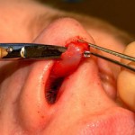 closed-endonasal-rhinoplasty-dr-barry-eppley-indianapolis