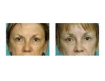 midface-lift-dr-barry-eppley-indianapolis