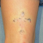 residual-tattoo-prior-to-excision-dr-barry-eppley-indianapolis