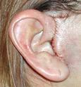 short-scar-facelift-incision-dr-barry-eppley-indianapolis