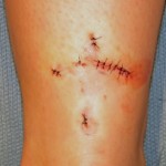 tattoo-excision-immediately-after-dr-barry-eppley-indianapolis