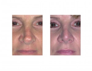 tip-rhinoplasty-dr-barry-eppley-indianapolis