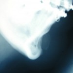 chin-implant-erosion-x-ray-dr-barry-eppley-indianapolis1