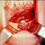 chin-implant-osteotomy-intraoperative-dr-barry-eppley-indianapolis