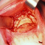 old-chin-implant-intraoperative-dr-barry-eppley-indianapolis