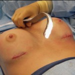lighted-retractor-for-breast-augmentation-dr-barry-eppley-indianapolis