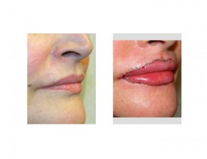 lip-advancement-before-and-after-dr-barry-eppley-indianapolis