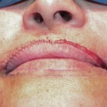 lip-advancement-intraoperative-dr-barry-eppley-indianapolis