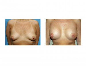 breast-augmentation-widely-spaced-breasts-dr-barry-eppley-indianapolis1